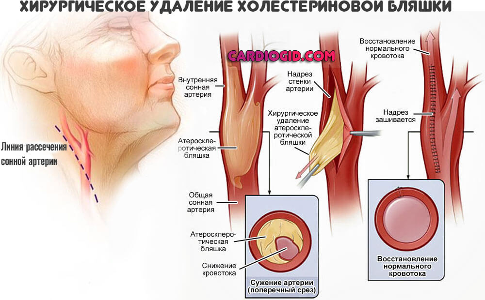 Атеросклероз сонной артерии слева thumbnail