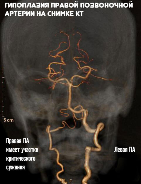 Гипоплазия и синдром позвоночной артерии thumbnail