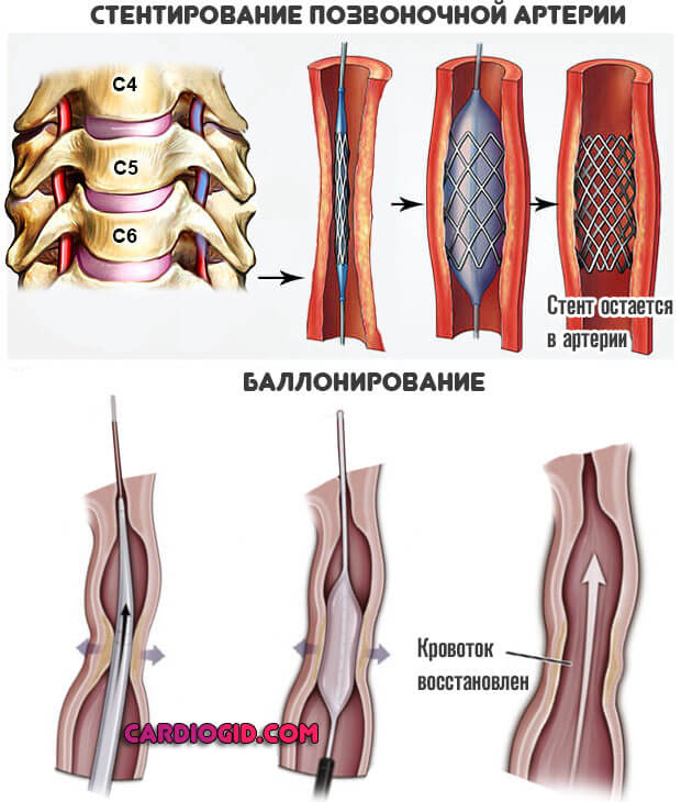Как вылечить гипоплазию позвоночной артерии thumbnail