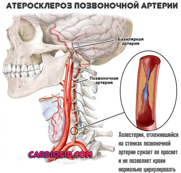 Основная артерия в позвоночнике thumbnail