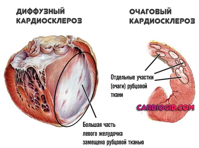 формы кардиосклероза