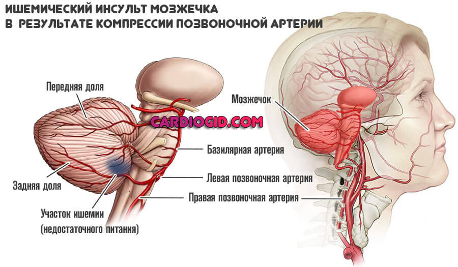 Синдром позвоночной артерии зажата позвоночная артерия thumbnail