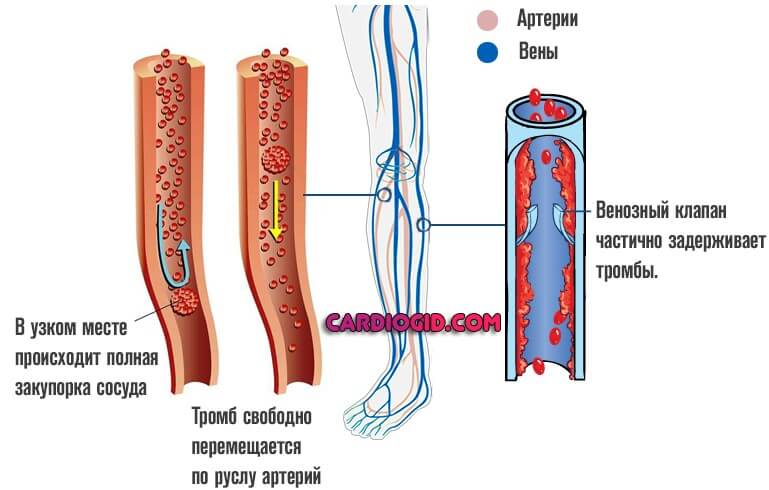 Чем опасны тромбы в венах на ногах лечение thumbnail