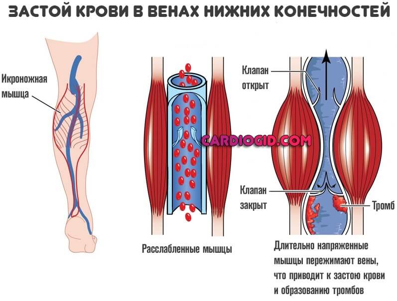 Восстановление кровотока в ногах при атеросклерозе малко thumbnail