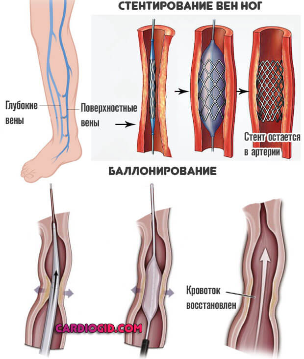 Улучшение кровообращения ног лечение thumbnail