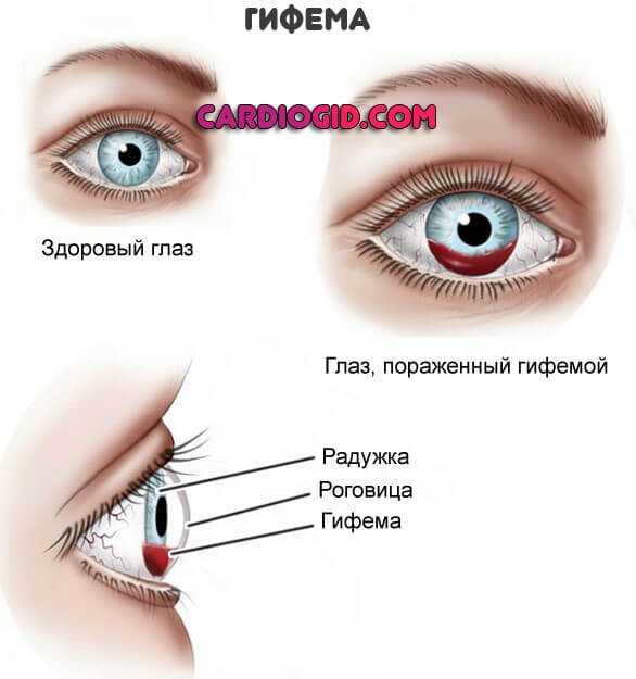 Кровоизлияния в глаза при гипертонии thumbnail