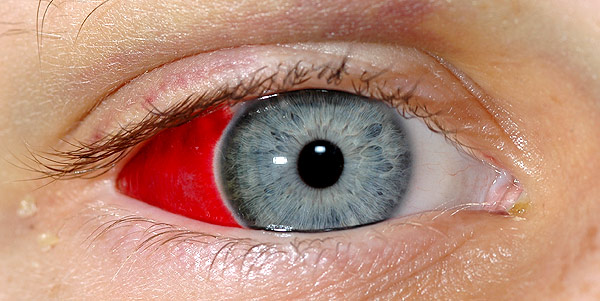 Внутреннее кровоизлияние глаза лечение thumbnail
