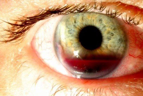 Кровоизлияние глаза при гипертонии thumbnail