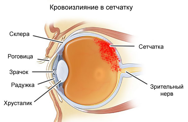 Кровоизлияния в глазу при гипертонии thumbnail