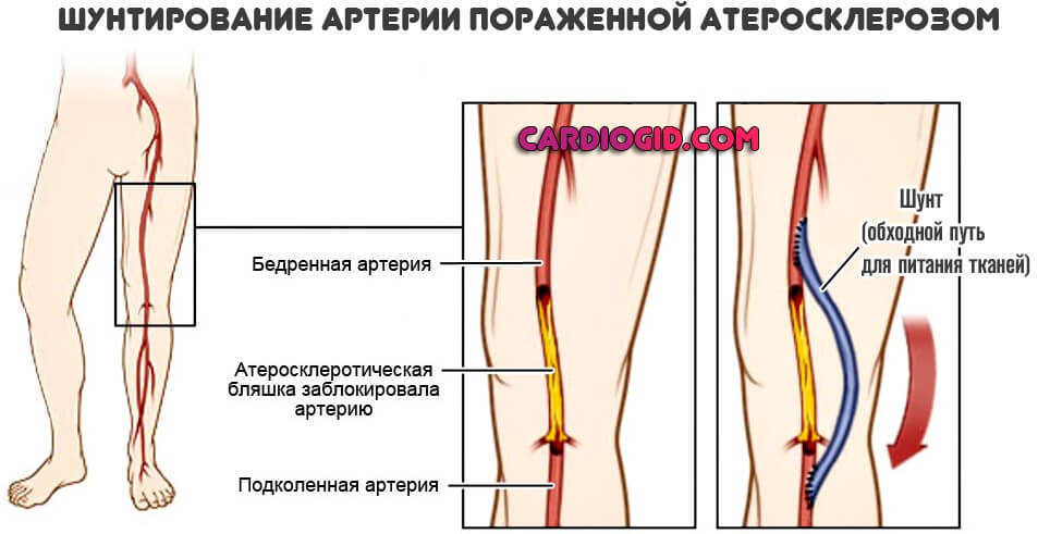 Атеросклероз нижних конечностей ног фото thumbnail