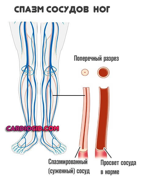 Атеросклероз сосудов нижних конечностей: симптомы и лечение - заболевания сердца