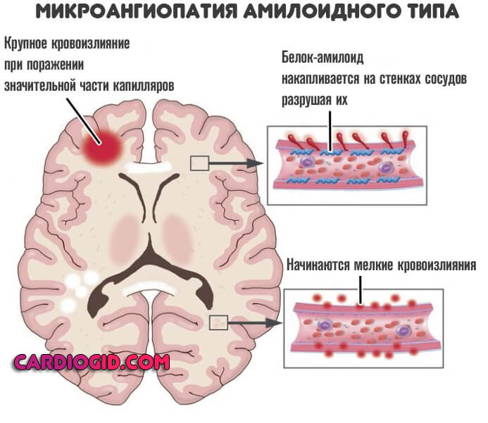 Заключение мрт головного мозга микроангиопатия thumbnail