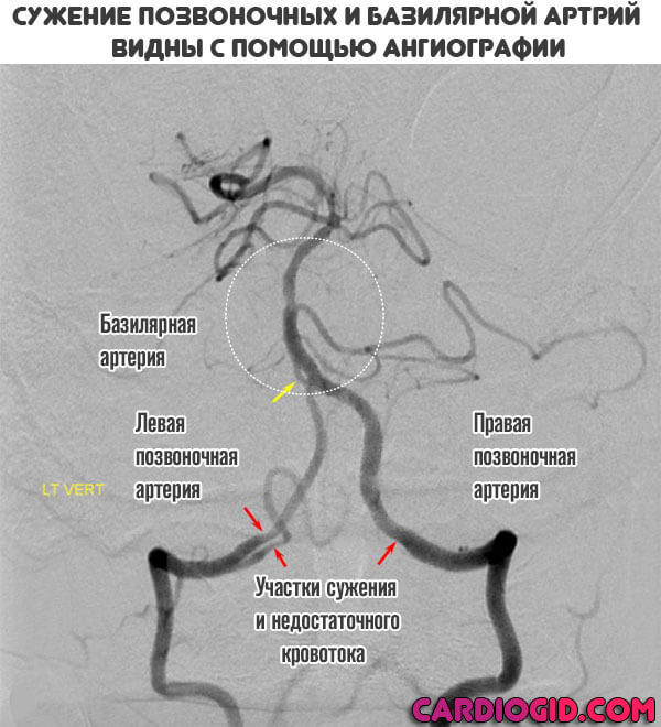 Что такое синдром вертебробазилярной артерии thumbnail
