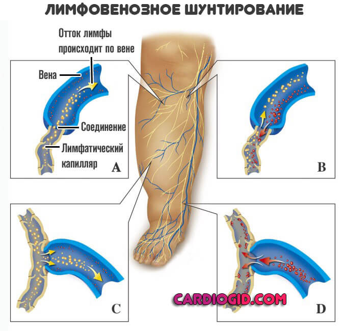 Односторонний лимфатический отек ноги thumbnail
