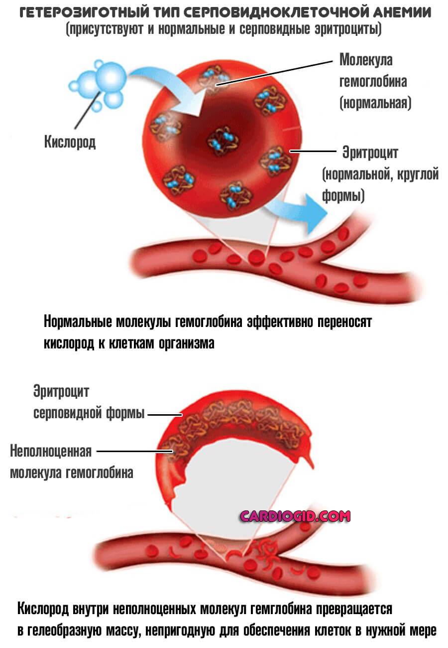 Профилактика серповидно клеточной анемии thumbnail