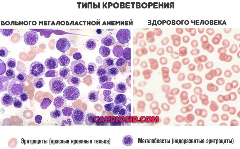 krovetvrenie pri megaloblastnoj anemii