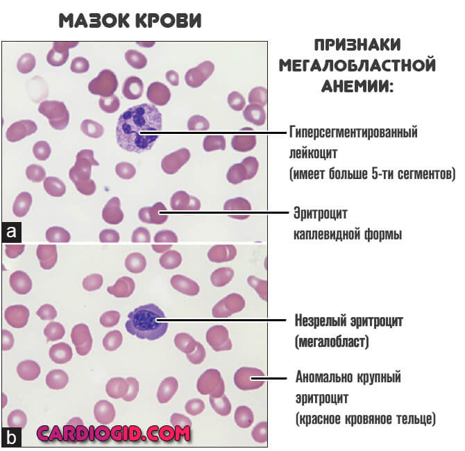 priznaki megaloblastnoj anemii v mazke krovi