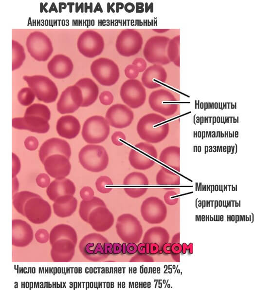 Нормы анизоцитоза в анализе крови thumbnail