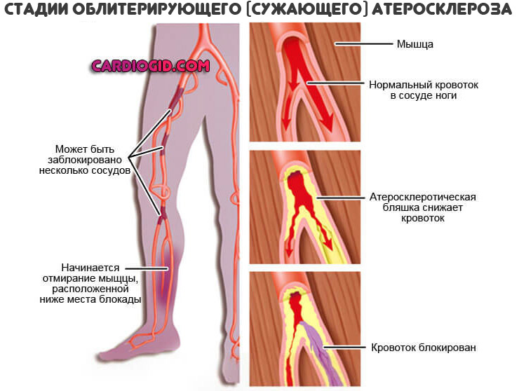 stadii obliteriruyushhego ateroskleroza