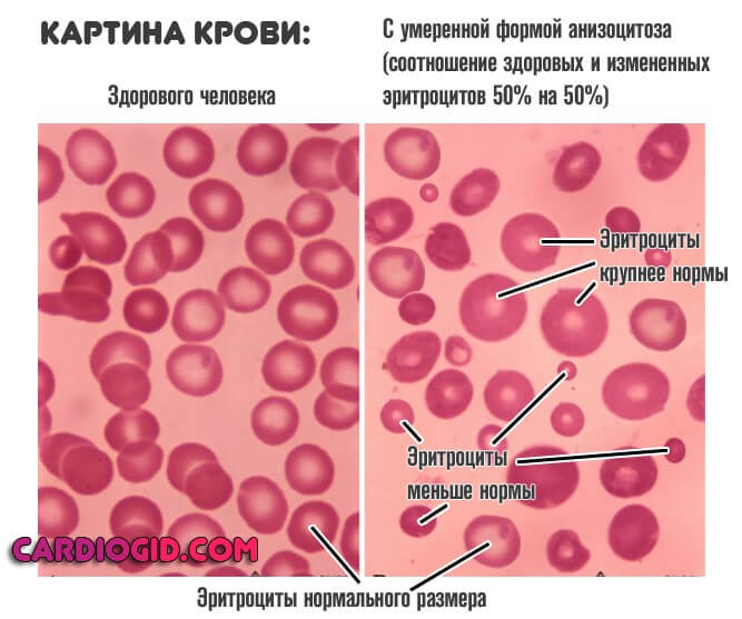 Что такое анизоцитоз в анализе крови смешанного типа thumbnail