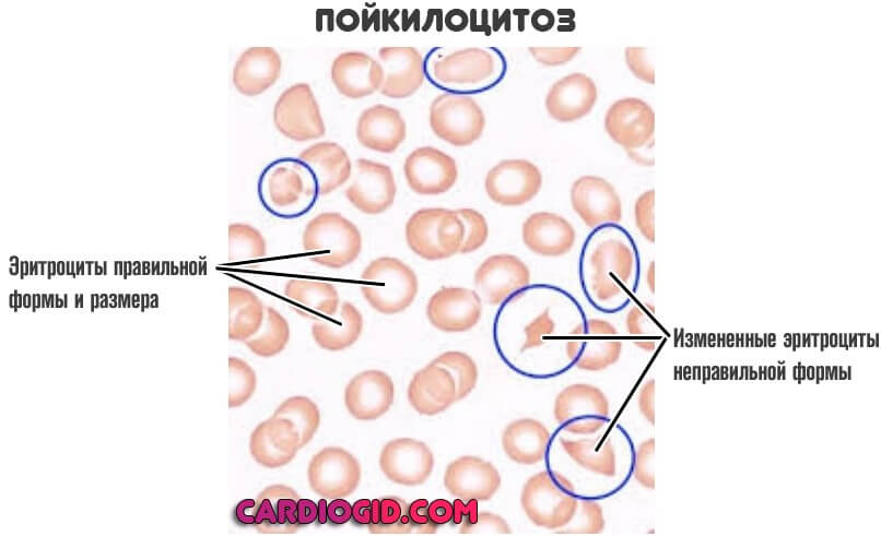 Анализ крови пойкилоцитоз норма thumbnail