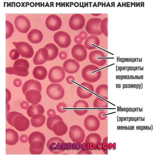 гипохромная микроцитарная анемия