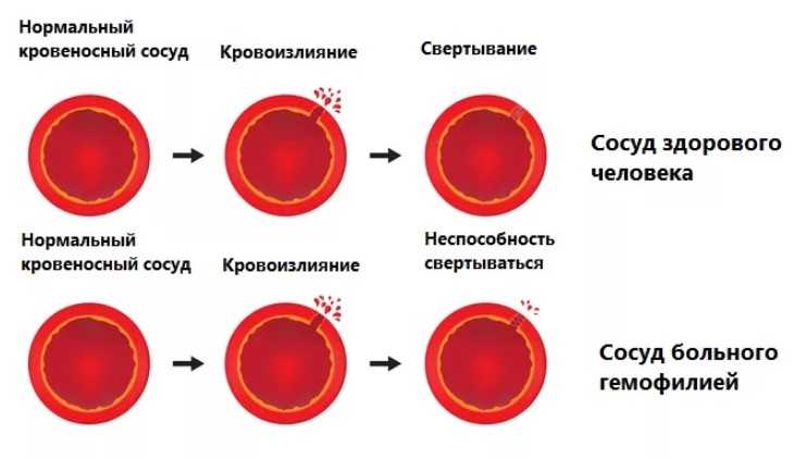 Анализ крови на mcv расшифровка thumbnail