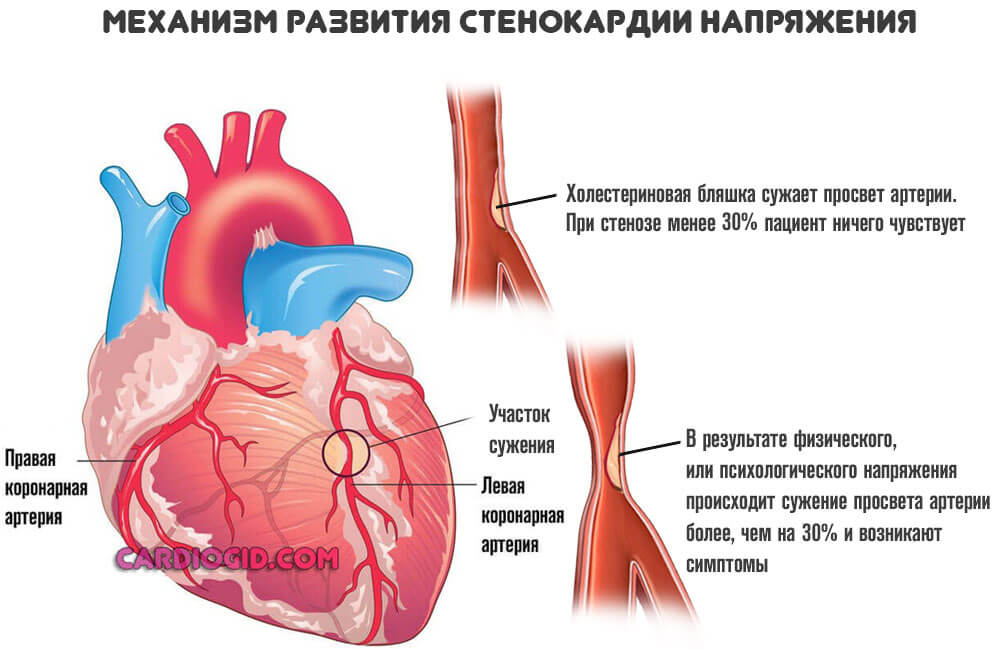 Противопоказания для операция шунтирование сердца thumbnail