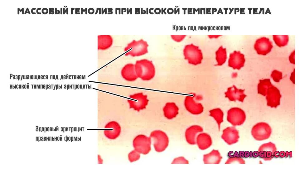 Разрушение эритроцитов с выходом гемоглобина называется thumbnail
