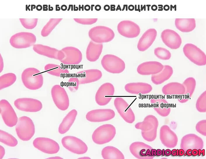 Хроническая гемолитическая анемия симптомы thumbnail